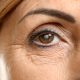 Woman with cataract in eye