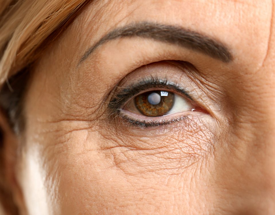 Woman with cataract in eye